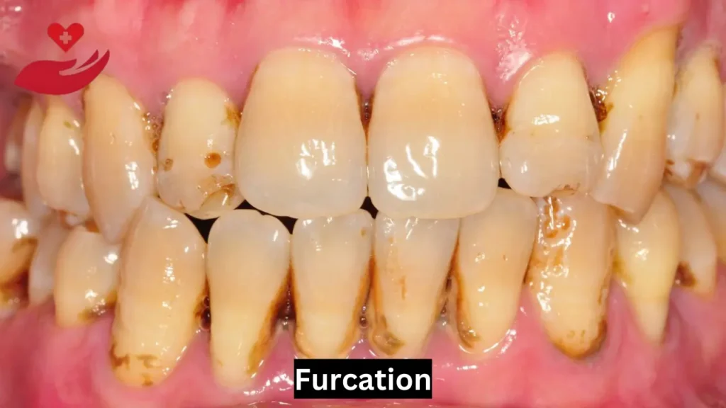 Furcation